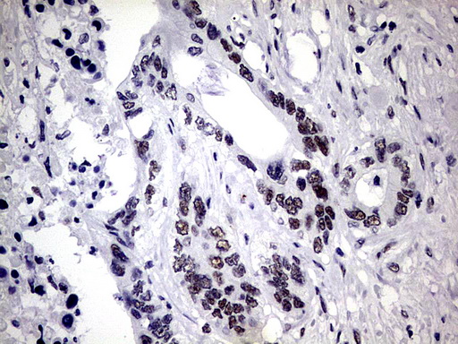 ZNF34 Antibody - IHC of paraffin-embedded Adenocarcinoma of Human colon tissue using anti-ZNF34 mouse monoclonal antibody. (Heat-induced epitope retrieval by 1 mM EDTA in 10mM Tris, pH8.5, 120°C for 3min).