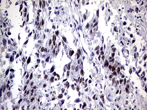 ZNF34 Antibody - IHC of paraffin-embedded Adenocarcinoma of Human ovary tissue using anti-ZNF34 mouse monoclonal antibody. (Heat-induced epitope retrieval by 1 mM EDTA in 10mM Tris, pH8.5, 120°C for 3min).