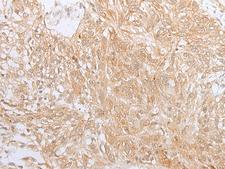ZNF34 Antibody - Immunohistochemistry of paraffin-embedded Human lung cancer tissue  using ZNF34 Polyclonal Antibody at dilution of 1:40(×200)