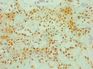 ZNF346 Antibody - Immunohistochemistry of paraffin-embedded human breast cancer using antibody at 1:100 dilution.