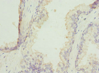 ZNF350 Antibody - Immunohistochemistry of paraffin-embedded human prostata cancer at dilution 1:100