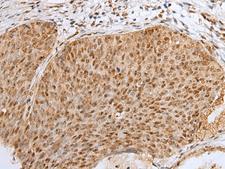 ZNF354A Antibody - Immunohistochemistry of paraffin-embedded Human cervical cancer tissue  using ZNF354A Polyclonal Antibody at dilution of 1:40(×200)