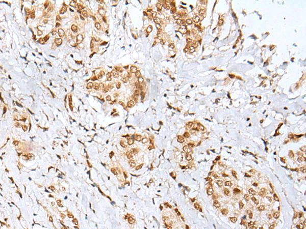 ZNF354A Antibody - Immunohistochemistry of paraffin-embedded Human breast cancer tissue  using ZNF354A Polyclonal Antibody at dilution of 1:40(×200)