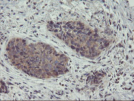 ZNF365 Antibody - IHC of paraffin-embedded Carcinoma of Human lung tissue using anti-ZNF365 mouse monoclonal antibody.