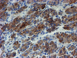 ZNF365 Antibody - IHC of paraffin-embedded Carcinoma of Human liver tissue using anti-ZNF365 mouse monoclonal antibody. (Heat-induced epitope retrieval by 10mM citric buffer, pH6.0, 100C for 10min).