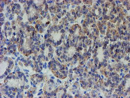 ZNF365 Antibody - IHC of paraffin-embedded Carcinoma of Human thyroid tissue using anti-ZNF365 mouse monoclonal antibody. (Heat-induced epitope retrieval by 10mM citric buffer, pH6.0, 100C for 10min).