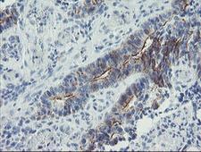 ZNF365 Antibody - IHC of paraffin-embedded Adenocarcinoma of Human colon tissue using anti-ZNF365 mouse monoclonal antibody.