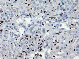 ZNF365 Antibody - IHC of paraffin-embedded Carcinoma of Human lung tissue using anti-ZNF365 mouse monoclonal antibody.