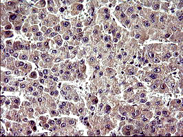 ZNF365 Antibody - IHC of paraffin-embedded Carcinoma of Human liver tissue using anti-ZNF365 mouse monoclonal antibody. (Heat-induced epitope retrieval by 10mM citric buffer, pH6.0, 120°C for 3min).