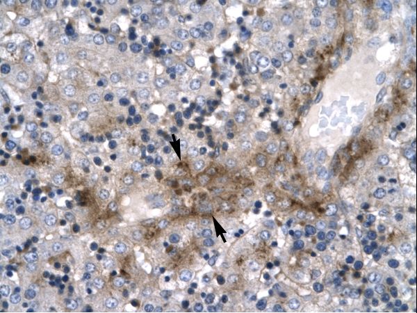ZNF365 Antibody - ZNF365 antibody ARP32290_P050-NP_955522-ZNF365 (zinc finger protein 365) Antibody was used in IHC to stain formalin-fixed, paraffin-embedded human liver.  This image was taken for the unconjugated form of this product. Other forms have not been tested.