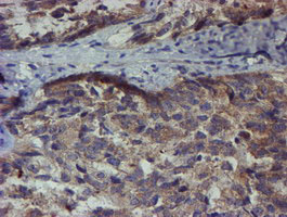 ZNF365 Antibody - IHC of paraffin-embedded Adenocarcinoma of Human ovary tissue using anti-ZNF365 mouse monoclonal antibody.