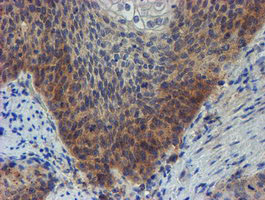 ZNF365 Antibody - IHC of paraffin-embedded Carcinoma of Human bladder tissue using anti-ZNF365 mouse monoclonal antibody.