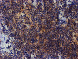 ZNF365 Antibody - IHC of paraffin-embedded Human lymphoma tissue using anti-ZNF365 mouse monoclonal antibody.