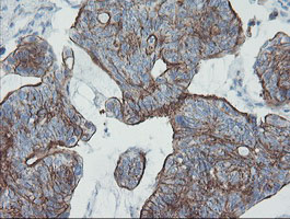 ZNF365 Antibody - IHC of paraffin-embedded Carcinoma of Human pancreas tissue using anti-ZNF365 mouse monoclonal antibody.