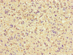 ZNF365 Antibody - Immunohistochemistry of paraffin-embedded human glioma cancer at dilution of 1:100