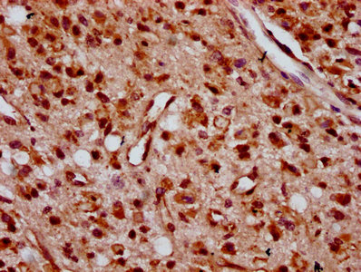 ZNF367 Antibody - Immunohistochemistry Dilution at 1:400 and staining in paraffin-embedded human glioma cancer performed on a Leica BondTM system. After dewaxing and hydration, antigen retrieval was mediated by high pressure in a citrate buffer (pH 6.0). Section was blocked with 10% normal Goat serum 30min at RT. Then primary antibody (1% BSA) was incubated at 4°C overnight. The primary is detected by a biotinylated Secondary antibody and visualized using an HRP conjugated SP system.