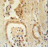 ZNF385B / ZNF533 Antibody - Z385B Antibody immunohistochemistry of formalin-fixed and paraffin-embedded human prostate carcinoma followed by peroxidase-conjugated secondary antibody and DAB staining.