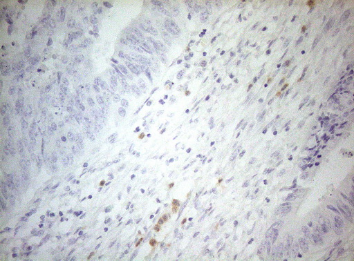 ZNF394 Antibody - Immunohistochemical staining of paraffin-embedded Adenocarcinoma of Human colon tissue using anti-ZNF394 mouse monoclonal antibody. (Heat-induced epitope retrieval by 1mM EDTA in 10mM Tris buffer. (pH8.5) at 120°C for 3 min. (1:150)