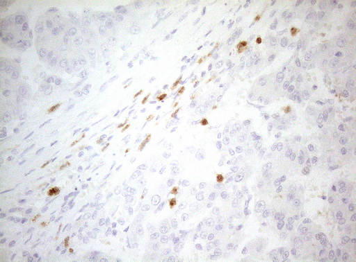 ZNF394 Antibody - Immunohistochemical staining of paraffin-embedded Carcinoma of Human liver tissue using anti-ZNF394 mouse monoclonal antibody. (Heat-induced epitope retrieval by 1mM EDTA in 10mM Tris buffer. (pH8.5) at 120°C for 3 min. (1:150)