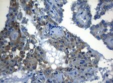 ZNF394 Antibody - Immunohistochemical staining of paraffin-embedded Carcinoma of Human thyroid tissue using anti-ZNF394 mouse monoclonal antibody. (Heat-induced epitope retrieval by 1mM EDTA in 10mM Tris buffer. (pH8.5) at 120°C for 3 min. (1:150)