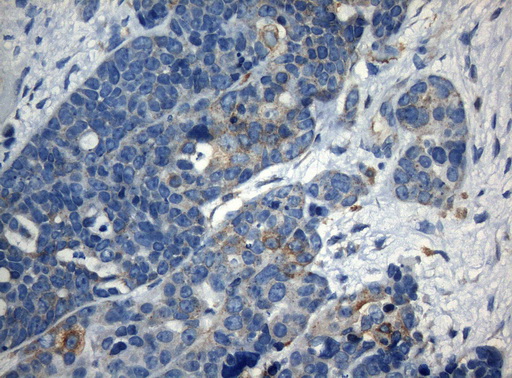 ZNF394 Antibody - Immunohistochemical staining of paraffin-embedded Adenocarcinoma of Human endometrium tissue using anti-ZNF394 mouse monoclonal antibody. (Heat-induced epitope retrieval by 1mM EDTA in 10mM Tris buffer. (pH8.5) at 120°C for 3 min. (1:150)