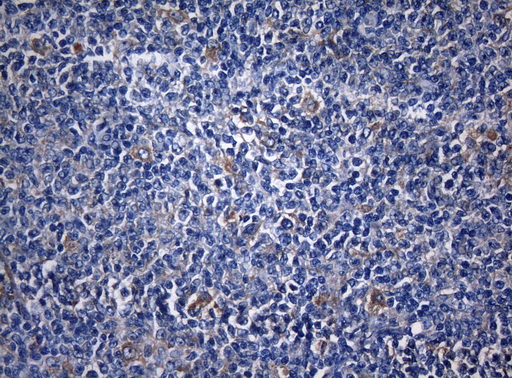 ZNF394 Antibody - Immunohistochemical staining of paraffin-embedded Human lymphoma tissue using anti-ZNF394 mouse monoclonal antibody. (Heat-induced epitope retrieval by 1mM EDTA in 10mM Tris buffer. (pH8.5) at 120°C for 3 min. (1:150)