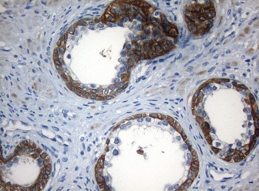 ZNF394 Antibody - Immunohistochemical staining of paraffin-embedded Carcinoma of Human prostate tissue using anti-ZNF394 mouse monoclonal antibody. (Heat-induced epitope retrieval by 1mM EDTA in 10mM Tris buffer. (pH8.5) at 120°C for 3 min. (1:150)