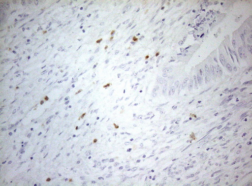 ZNF394 Antibody - Immunohistochemical staining of paraffin-embedded Adenocarcinoma of Human colon tissue using anti-ZNF394 mouse monoclonal antibody. (Heat-induced epitope retrieval by 1mM EDTA in 10mM Tris buffer. (pH8.5) at 120°C for 3 min. (1:150)