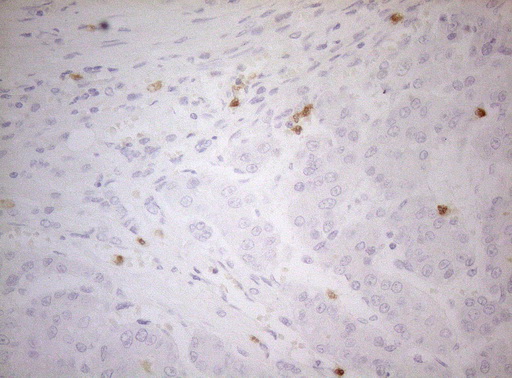 ZNF394 Antibody - Immunohistochemical staining of paraffin-embedded Carcinoma of Human liver tissue using anti-ZNF394 mouse monoclonal antibody. (Heat-induced epitope retrieval by 1mM EDTA in 10mM Tris buffer. (pH8.5) at 120°C for 3 min. (1:150)
