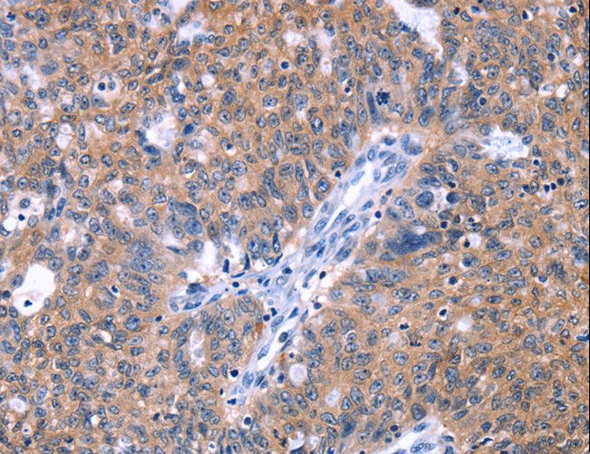 ZNF395 Antibody - Immunohistochemistry of paraffin-embedded Human ovarian cancer using ZNF395 Polyclonal Antibody at dilution of 1:40.