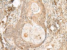 ZNF397 Antibody - Immunohistochemistry of paraffin-embedded Human esophagus cancer tissue  using ZNF397 Polyclonal Antibody at dilution of 1:80(×200)