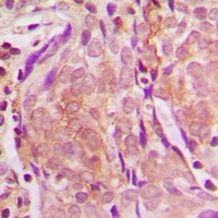 ZNF397 Antibody - Immunohistochemical analysis of ZNF397 staining in human breast cancer formalin fixed paraffin embedded tissue section. The section was pre-treated using heat mediated antigen retrieval with sodium citrate buffer (pH 6.0). The section was then incubated with the antibody at room temperature and detected with HRP and DAB as chromogen. The section was then counterstained with hematoxylin and mounted with DPX.
