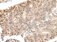 ZNF410 Antibody - Immunohistochemistry of paraffin-embedded Human colorectal cancer tissue  using ZNF410 Polyclonal Antibody at dilution of 1:40(×200)
