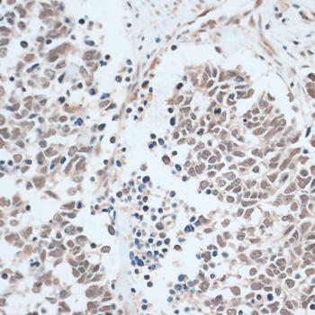 ZNF416 Antibody - Immunohistochemistry of paraffin-embedded Human lung cancer using ZNF416 Polyclonal Antibody at dilution of 1:100 (40x lens).