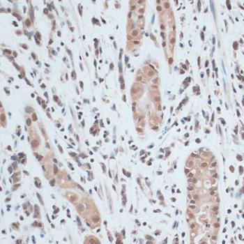 ZNF416 Antibody - Immunohistochemistry of paraffin-embedded Human gastric cancer using ZNF416 Polyclonal Antibody at dilution of 1:100 (40x lens).