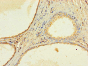 ZNF432 Antibody - Immunohistochemistry of paraffin-embedded human prostate cancer using ZNF432 Antibody at dilution of 1:100