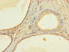 ZNF432 Antibody - Immunohistochemistry of paraffin-embedded human prostate cancer using ZNF432 Antibody at dilution of 1:100