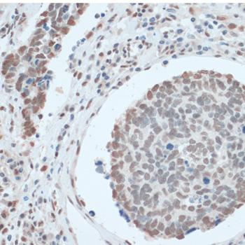 ZNF433 Antibody - Immunohistochemistry of paraffin-embedded Human lung cancer using ZNF433 Polyclonal Antibody at dilution of 1:100 (40x lens).