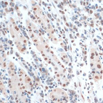 ZNF433 Antibody - Immunohistochemistry of paraffin-embedded Human gastric cancer using ZNF433 Polyclonal Antibody at dilution of 1:100 (40x lens).
