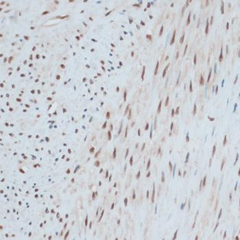 ZNF433 Antibody - Immunohistochemistry of paraffin-embedded Human uterine cancer using ZNF433 Polyclonal Antibody at dilution of 1:100 (40x lens).