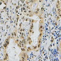 ZNF436 Antibody - Immunohistochemical analysis of ZNF436 staining in human lung cancer formalin fixed paraffin embedded tissue section. The section was pre-treated using heat mediated antigen retrieval with sodium citrate buffer (pH 6.0). The section was then incubated with the antibody at room temperature and detected with HRP and DAB as chromogen. The section was then counterstained with hematoxylin and mounted with DPX.
