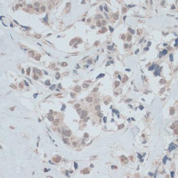 ZNF446 Antibody - Immunohistochemistry of paraffin-embedded Human breast cancer using ZNF446 Polyclonal Antibody at dilution of 1:100 (40x lens).