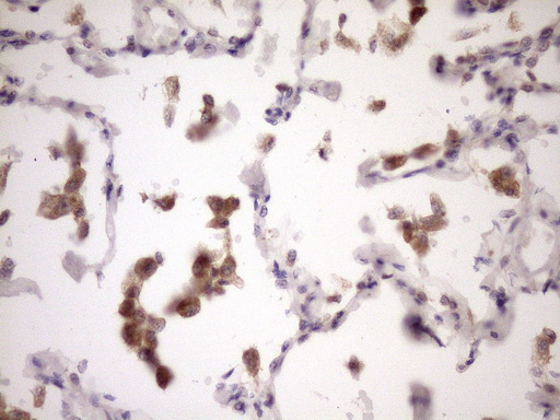 ZNF449 Antibody - Immunohistochemical staining of paraffin-embedded Carcinoma of Human lung tissue using anti-ZNF449 mouse monoclonal antibody. (Heat-induced epitope retrieval by Tris-EDTA, pH8.0)(1:150)