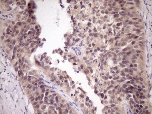ZNF449 Antibody - Immunohistochemical staining of paraffin-embedded Carcinoma of Human kidney tissue using anti-ZNF449 mouse monoclonal antibody. (Heat-induced epitope retrieval by Tris-EDTA, pH8.0)(1:150)