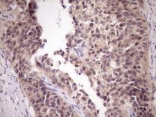 ZNF449 Antibody - IHC of paraffin-embedded Carcinoma of Human kidney tissue using anti-ZNF449 mouse monoclonal antibody. (Heat-induced epitope retrieval by Tris-EDTA, pH8.0)(1:150).