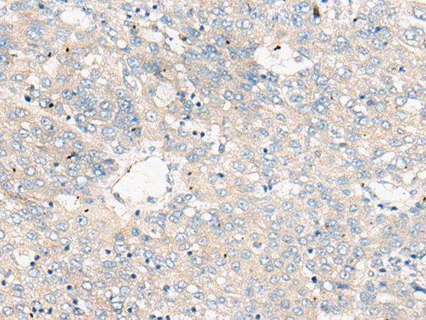 ZNF449 Antibody - Immunohistochemistry of paraffin-embedded Human liver cancer tissue  using ZNF449 Polyclonal Antibody at dilution of 1:50(×200)