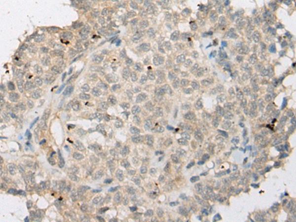ZNF449 Antibody - Immunohistochemistry of paraffin-embedded Human ovarian cancer tissue  using ZNF449 Polyclonal Antibody at dilution of 1:50(×200)