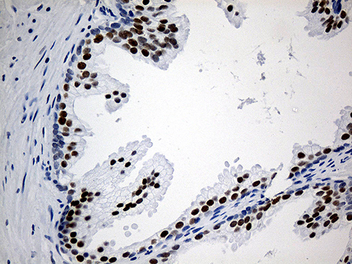 ZNF454 Antibody - Immunohistochemical staining of paraffin-embedded Carcinoma of Human prostate tissue using anti-ZNF454 mouse monoclonal antibody. (Heat-induced epitope retrieval by 1mM EDTA in 10mM Tris buffer. (pH8.5) at 120°C for 3 min. (1:150)