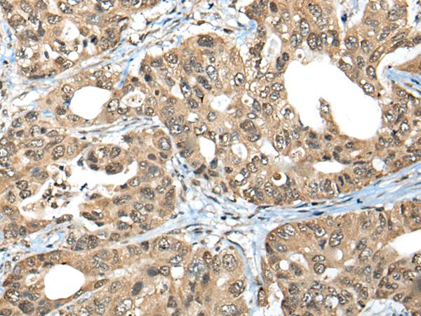 ZNF468 Antibody - Immunohistochemistry of paraffin-embedded Human gastric cancer tissue  using ZNF468 Polyclonal Antibody at dilution of 1:35(×200)