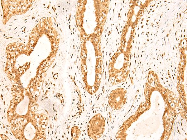 ZNF471 Antibody - Immunohistochemistry of paraffin-embedded Human breast cancer tissue  using ZNF471 Polyclonal Antibody at dilution of 1:50(×200)